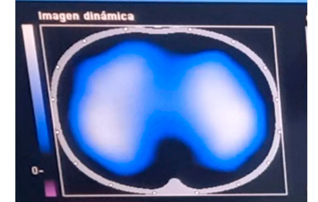 Imágenes de tomografía que se toman para analizar el desempeño de la fisioterapia con el inventivo Ubicu Imágenes de tomografía que se toman para analizar el desempeño de la fisioterapia con el inventivo Ubicu