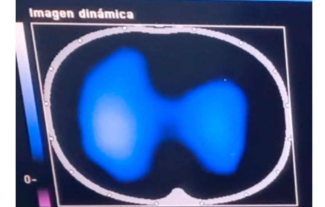 Imágenes de tomografía que se toman para analizar el desempeño de la fisioterapia con el inventivo Ubicu Imágenes de tomografía que se toman para analizar el desempeño de la fisioterapia con el inventivo Ubicu