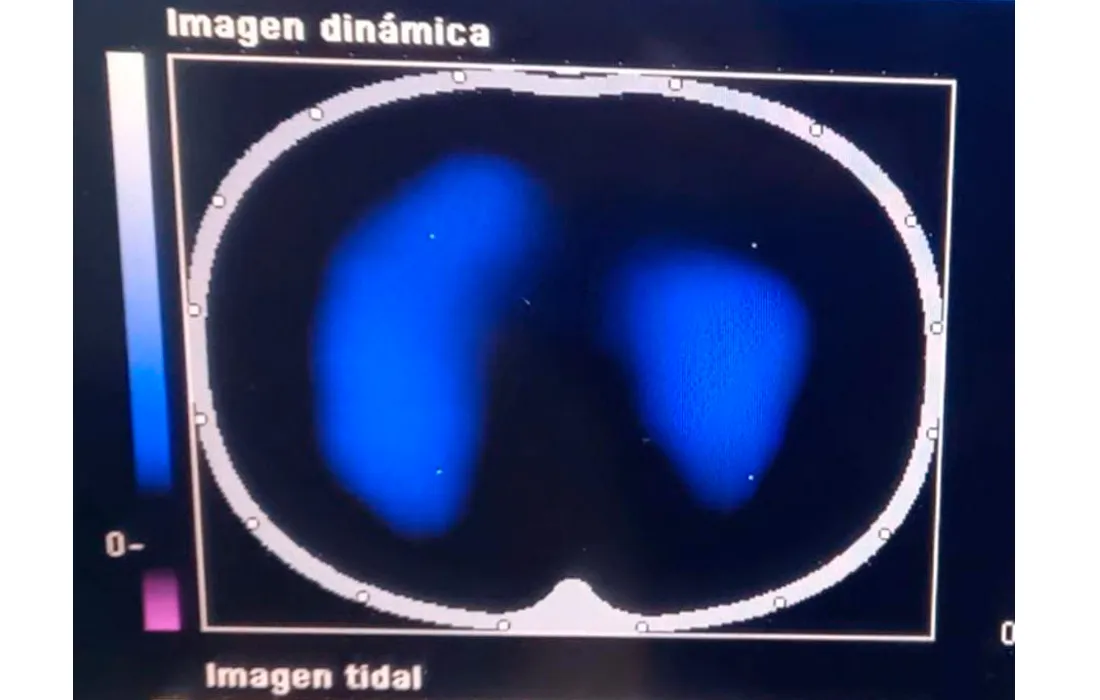Imágenes de tomografía que se toman para analizar el desempeño de la fisioterapia con el inventivo Ubicu Imágenes de tomografía que se toman para analizar el desempeño de la fisioterapia con el inventivo Ubicu