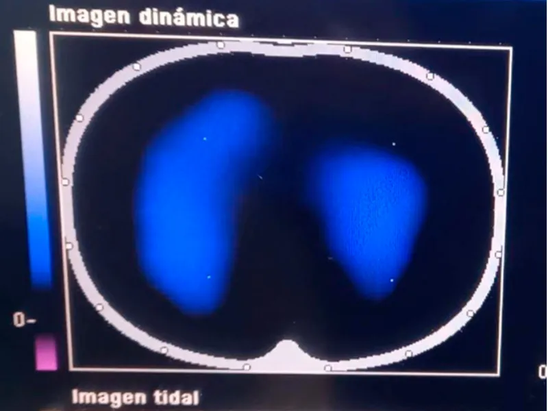 Imágenes de tomografía que se toman para analizar el desempeño de la fisioterapia con el inventivo Ubicu